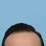 Fue Before and After | Dr. Jeffrey Wise
