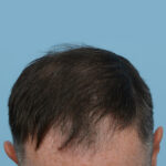 Fue Before and After | Dr. Jeffrey Wise
