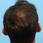 Fue Before and After | Dr. Jeffrey Wise