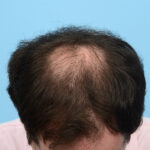 Fue Before and After | Dr. Jeffrey Wise