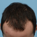 Fue Before and After | Dr. Jeffrey Wise