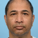 Fue Before and After | Dr. Jeffrey Wise