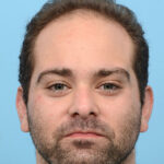 Fue Before and After | Dr. Jeffrey Wise