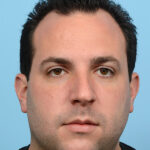 Fue Before and After | Dr. Jeffrey Wise