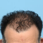 Fue Before and After | Dr. Jeffrey Wise