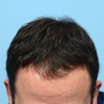 Fue Before and After | Dr. Jeffrey Wise