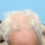 Fue Before and After | Dr. Jeffrey Wise