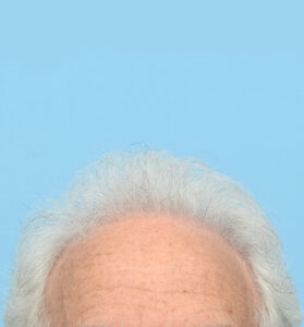 Fue Before and After | Dr. Jeffrey Wise