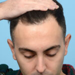 Fue Before and After | Dr. Jeffrey Wise