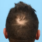 Fue Before and After | Dr. Jeffrey Wise