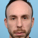 Fue Before and After | Dr. Jeffrey Wise
