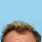 Fue Before and After | Dr. Jeffrey Wise