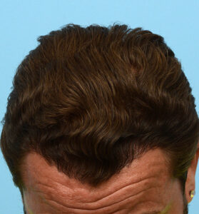 Fue Before and After | Dr. Jeffrey Wise