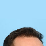 Fue Before and After | Dr. Jeffrey Wise