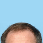 Fue Before and After | Dr. Jeffrey Wise