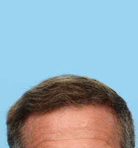 Fue Before and After | Dr. Jeffrey Wise