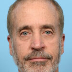 Fue Before and After | Dr. Jeffrey Wise