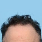 Fue Before and After | Dr. Jeffrey Wise