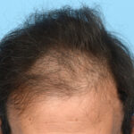 Fue Before and After | Dr. Jeffrey Wise