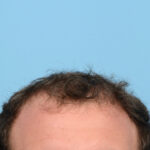Fue Before and After | Dr. Jeffrey Wise