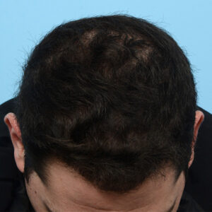 Fue Before and After | Dr. Jeffrey Wise