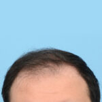 Fue Before and After | Dr. Jeffrey Wise