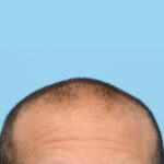 Fue Before and After | Dr. Jeffrey Wise