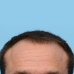 Fue Before and After | Dr. Jeffrey Wise