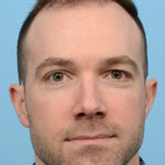 Fue Before and After | Dr. Jeffrey Wise
