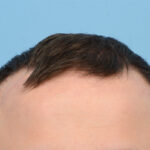 Fue Before and After | Dr. Jeffrey Wise
