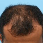 Fue Before and After | Dr. Jeffrey Wise