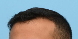 Fue Before and After | Dr. Jeffrey Wise