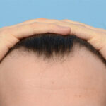 Fue Before and After | Dr. Jeffrey Wise
