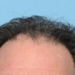 Fue Before and After | Dr. Jeffrey Wise