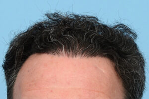 Fue Before and After | Dr. Jeffrey Wise