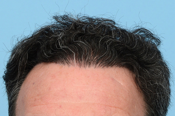 Fue Before and After | Dr. Jeffrey Wise