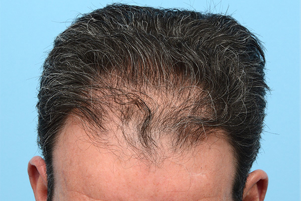 Fue Before and After | Dr. Jeffrey Wise