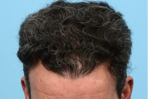 Fue Before and After | Dr. Jeffrey Wise