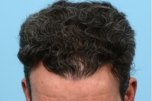 Fue Before and After | Dr. Jeffrey Wise