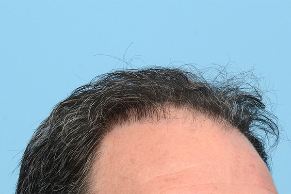 Fue Before and After | Dr. Jeffrey Wise