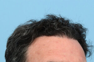 Fue Before and After | Dr. Jeffrey Wise