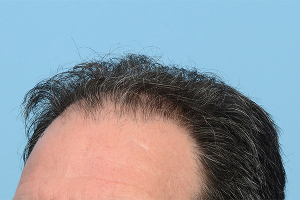 Fue Before and After | Dr. Jeffrey Wise