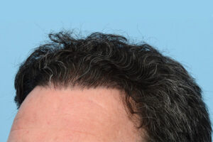 Fue Before and After | Dr. Jeffrey Wise