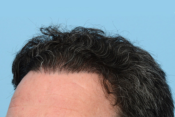 Fue Before and After | Dr. Jeffrey Wise