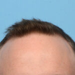 Fue Before and After | Dr. Jeffrey Wise