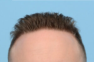 Fue Before and After | Dr. Jeffrey Wise