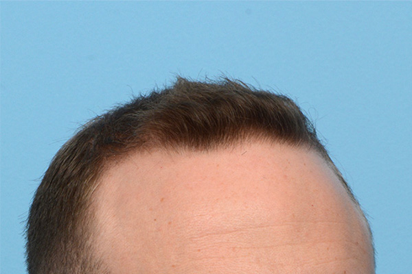 Fue Before and After | Dr. Jeffrey Wise