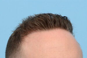 Fue Before and After | Dr. Jeffrey Wise