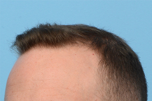 Fue Before and After | Dr. Jeffrey Wise