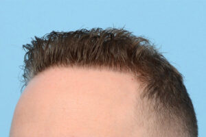 Fue Before and After | Dr. Jeffrey Wise